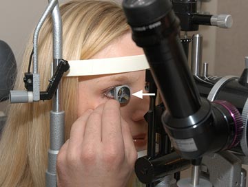 performing gonioscopy with contact lens and slit lamp microscope 